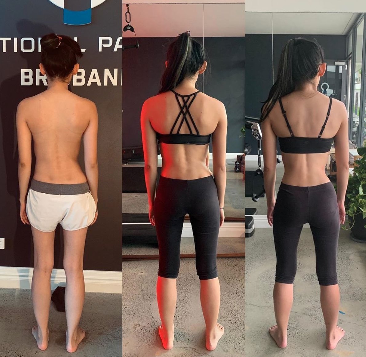 Naturally Straightened Scoliosis