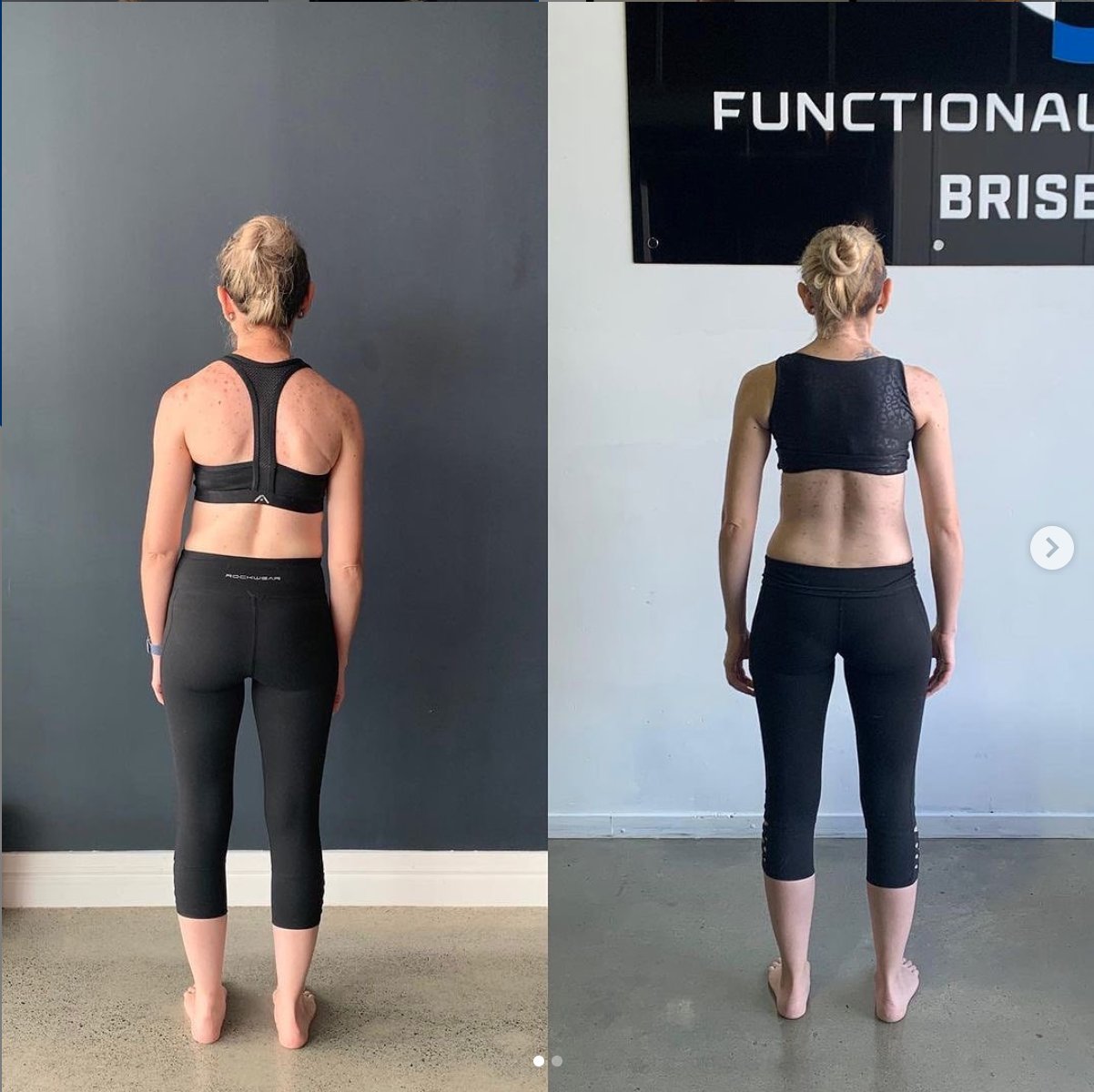 Can You Fix Scoliosis Naturally With A Scoliosis Specialist?