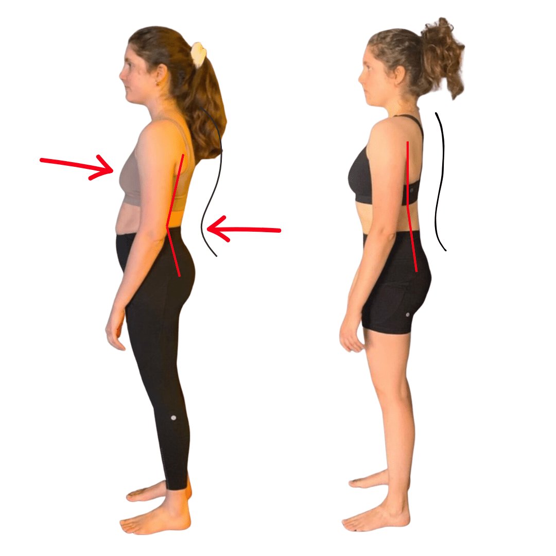 How to fix kyphosis posture