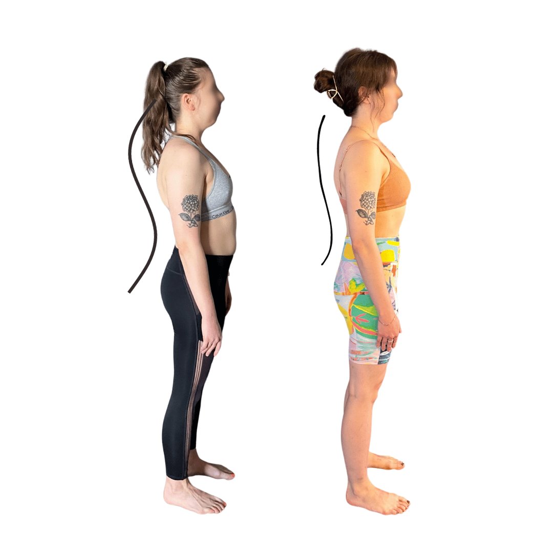 Everything You Need to Know About Kyphosis and How to Fix It