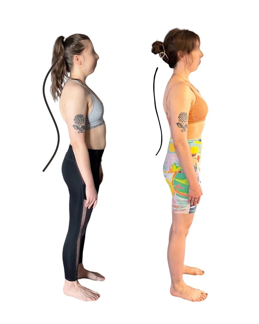 Kyphosis reduced naturally