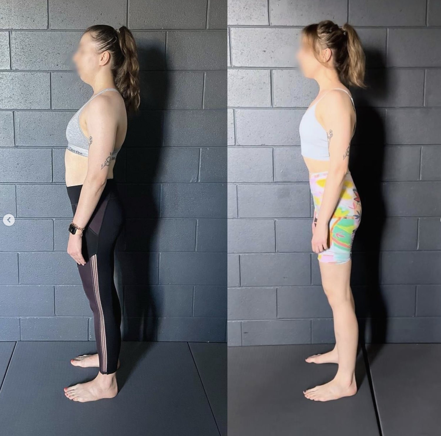 how to get rid of neck hump