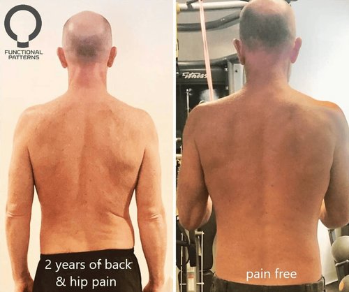 How to fix scoliosis naturally — Scoliosis Physiotherapy VS Functional Patterns