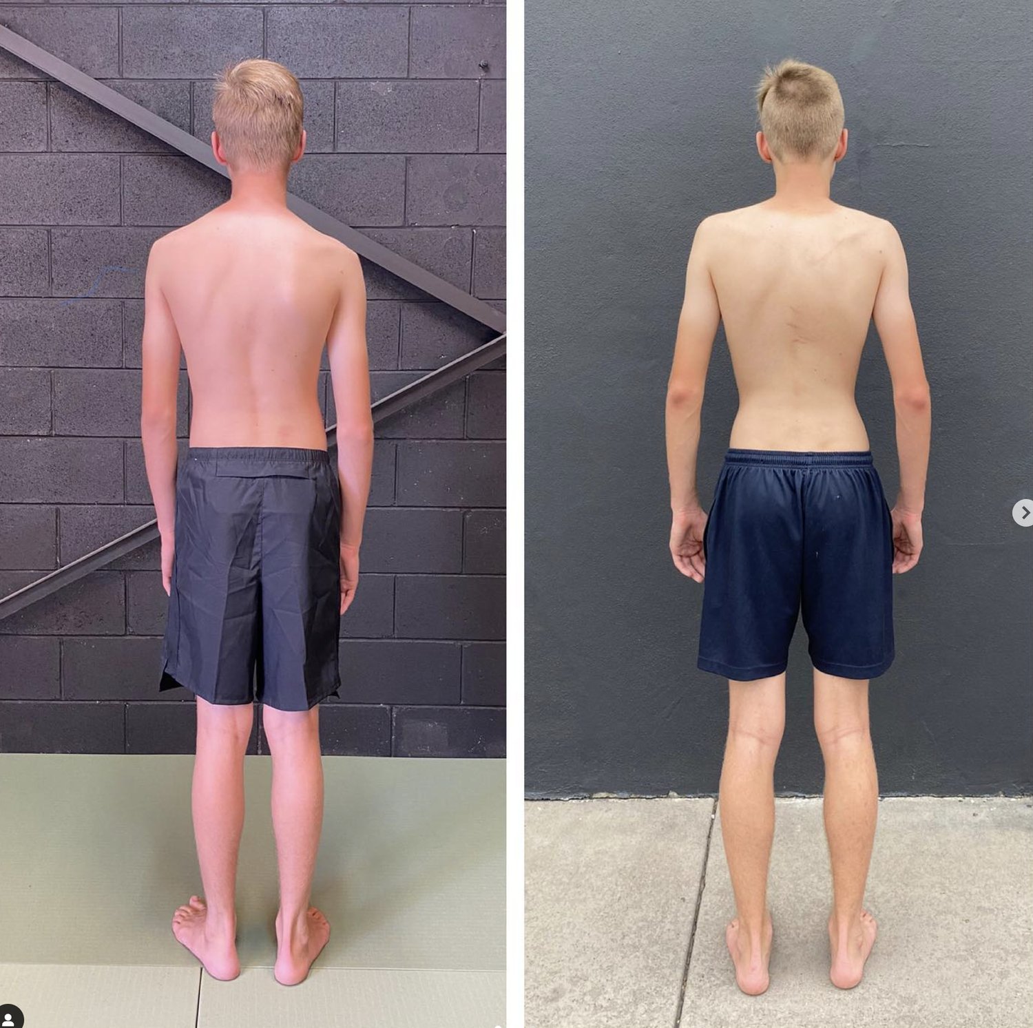 Scoliosis Physiotherapy VS Functional Patterns