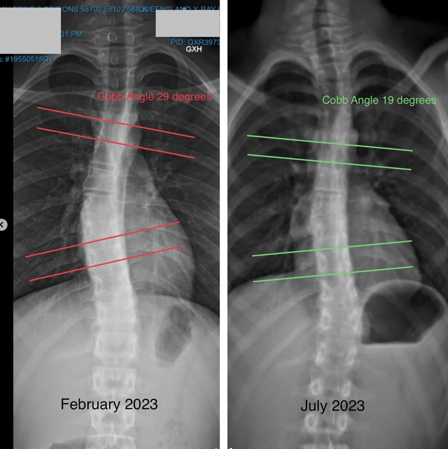 Scoliosis Physiotherapy VS Functional Patterns