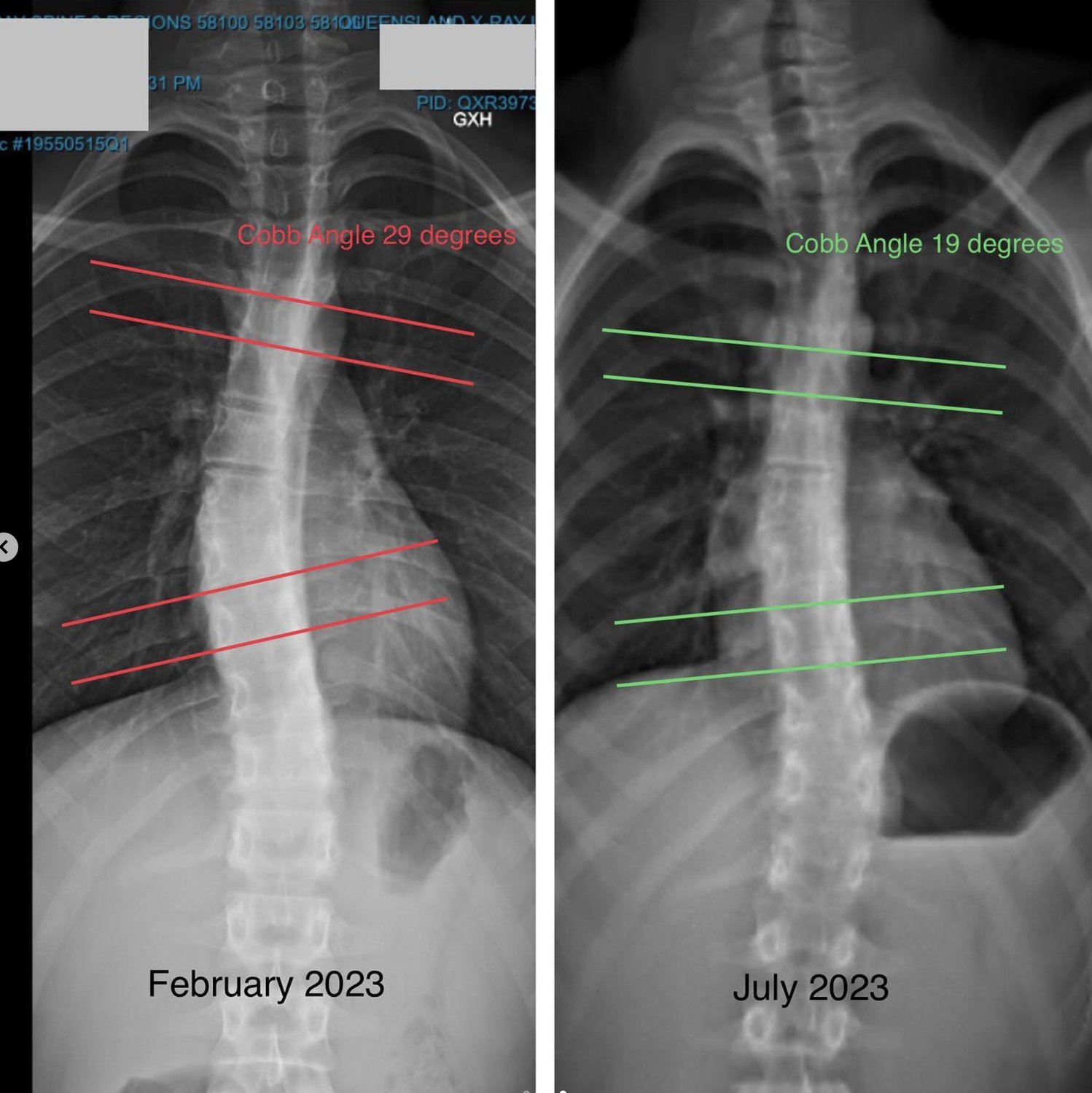 Scoliosis Physiotherapy VS Functional Patterns