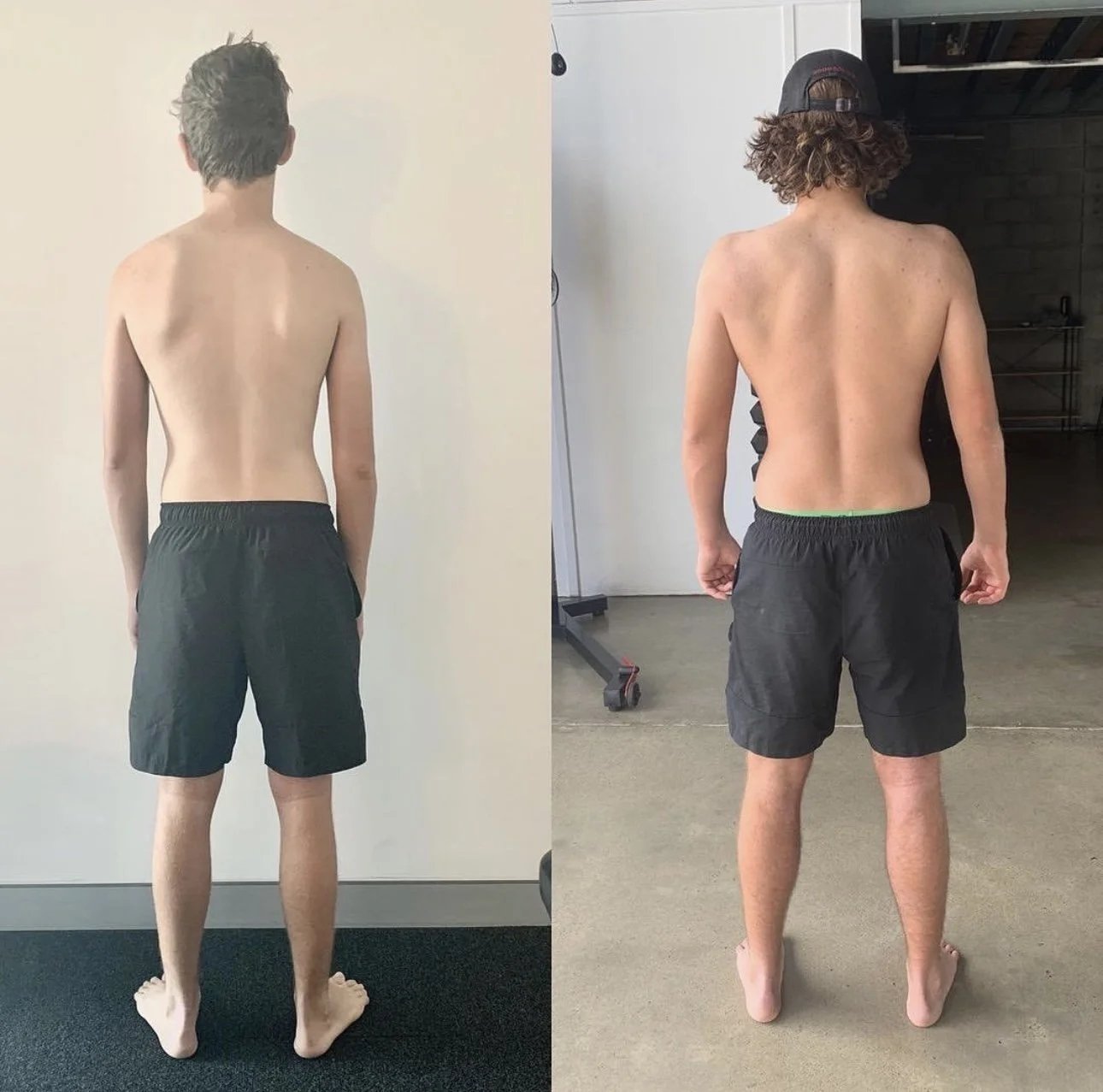 Achieving Thoracic Outlet Decompression