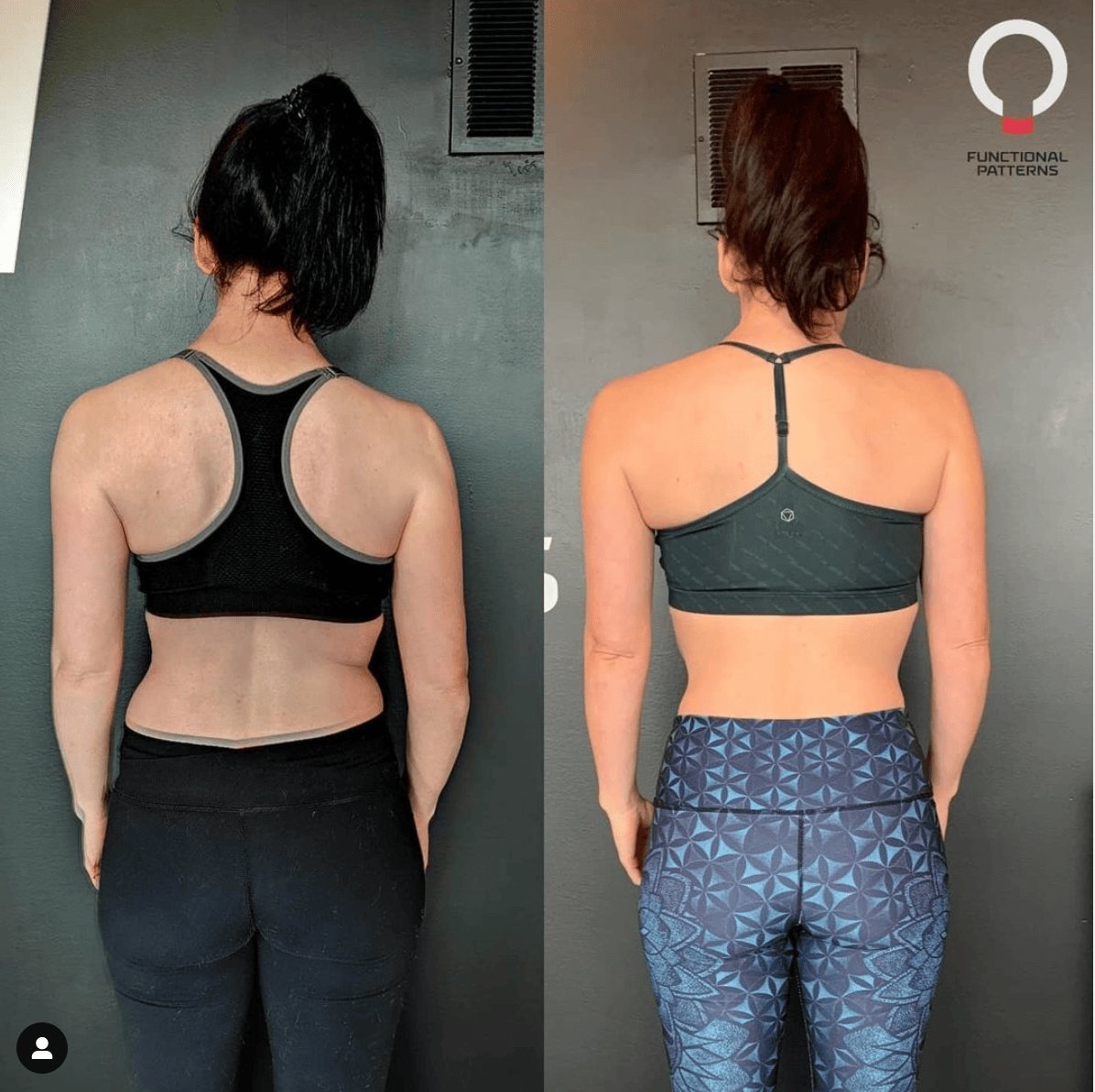 Achieving Thoracic Outlet Decompression