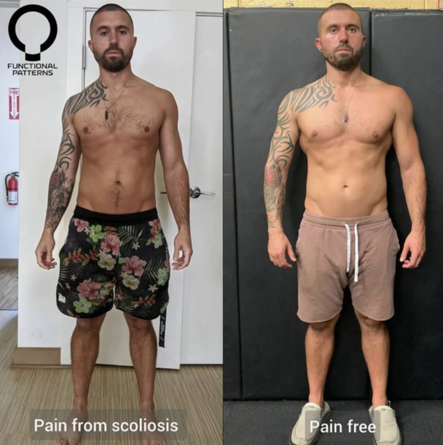 Thoracic Outlet Decompression - Surgery Vs Functional Movement