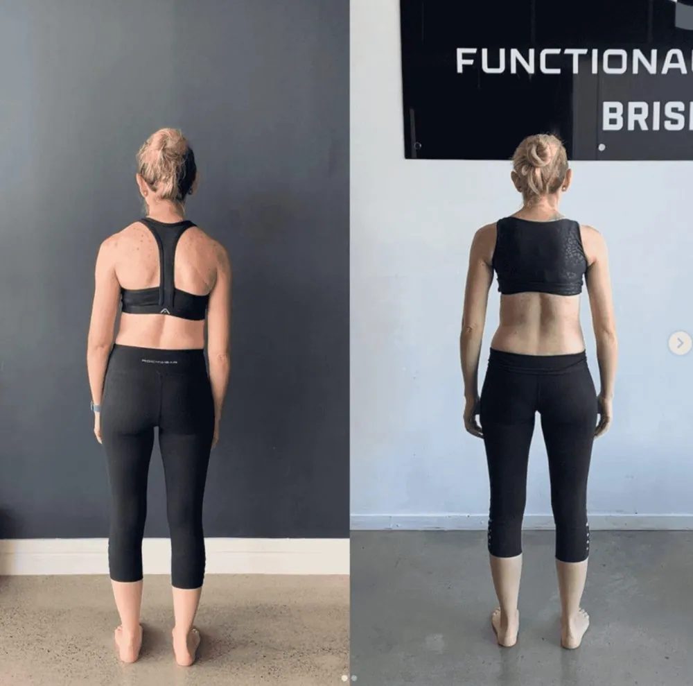 Scoliosis correction before and after — Functional Patterns Brisbane